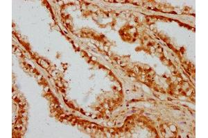 IHC image of ABIN7148764 diluted at 1:300 and staining in paraffin-embedded human prostate cancer performed on a Leica BondTM system. (CAND1 antibody  (AA 1150-1230))