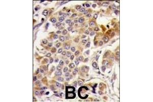 Formalin-fixed and paraffin-embedded human breast carcinoma tissue reacted with PRKp, which was peroxidase-conjugated to the secondary antibody, followed by DAB staining. (AMPK alpha antibody  (AA 474-502))