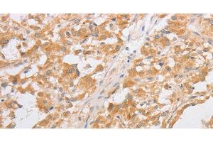 Immunohistochemistry of paraffin-embedded Human thyroid cancer tissue using CDKN2AIP Polyclonal Antibody at dilution 1:40 (CDKN2AIP antibody)