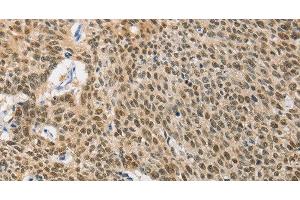Immunohistochemistry of paraffin-embedded Human lung cancer using HSP40 Polyclonal Antibody at dilution of 1:40 (DNAJB1 antibody)