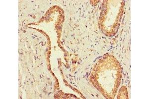Immunohistochemistry of paraffin-embedded human prostate cancer using ABIN7174476 at dilution of 1:100 (UBE2Q2 antibody  (AA 1-375))