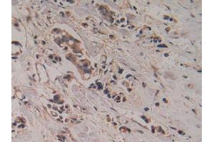 IHC-P analysis of CHuman Breast Cancer Tissue, with DAB staining. (CKMT1A antibody  (AA 41-250))