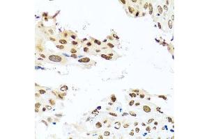 Immunohistochemistry of paraffin-embedded human lung cancer using RAB3IP antibody.