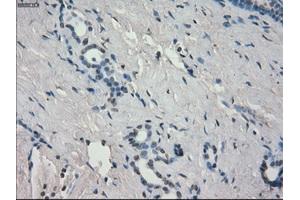 Immunohistochemical staining of paraffin-embedded Adenocarcinoma of breast tissue using anti-AURKC mouse monoclonal antibody. (Aurora Kinase C antibody)