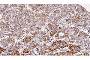 ABIN6272296 at 1/100 staining Human liver cancer tissue by IHC-P. (ELTD1 antibody  (Internal Region))