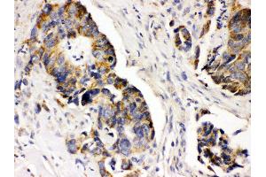 Anti- PDGFRA Picoband antibody, IHC(P) IHC(P): Human Intestinal Cancer Tissue (PDGFRA antibody  (C-Term))