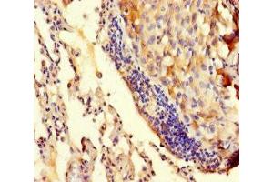 Immunohistochemistry of paraffin-embedded human lung cancer using ABIN7173512 at dilution of 1:100