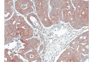IHC-P Image Immunohistochemical analysis of paraffin-embedded Gastric CA N87 xenograft, using MPI, antibody at 1:100 dilution. (MPI antibody)