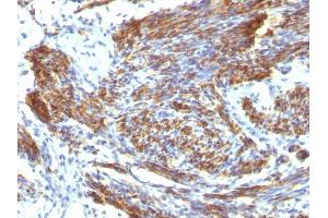 Formalin-fixed, paraffin-embedded human Leiomyosarcoma stained with Caldesmon Mouse Monoclonal Antibody (CALD1/820). (Caldesmon antibody)