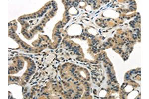 The image on the left is immunohistochemistry of paraffin-embedded Human thyroid cancer tissue using ABIN7193040(WDR36 Antibody) at dilution 1/35, on the right is treated with synthetic peptide. (WDR36 antibody)