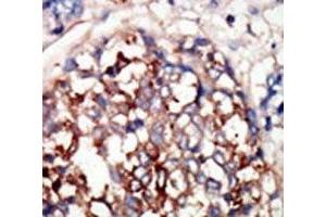 IHC analysis of FFPE human hepatocarcinoma tissue stained with the DYRKB antibody (DYRK1B antibody  (AA 561-589))