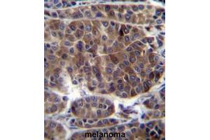 PRAMEF3 Antibody (C-term) immunohistochemistry analysis in formalin fixed and paraffin embedded human melanoma followed by peroxidase conjugation of the secondary antibody and DAB staining. (PRAMEF3 antibody  (C-Term))
