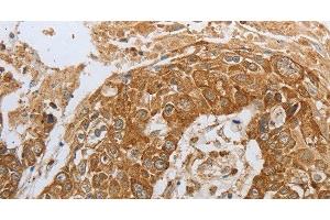 Immunohistochemistry of paraffin-embedded Human esophagus cancer using CKM Polyclonal Antibody at dilution of 1:50 (CKM antibody)
