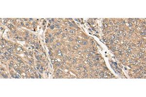 Immunohistochemistry of paraffin-embedded Human liver cancer tissue using C17orf67 Polyclonal Antibody at dilution of 1:50(x200) (C17ORF67 antibody)