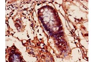 Immunohistochemistry of paraffin-embedded human colon cancer using ABIN7164206 at dilution of 1:100 (PFDN1 antibody  (AA 2-122))