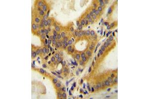CC85C Antibody (N-term) (ABIN654469 and ABIN2844203) immunohistochemistry analysis in formalin fixed and paraffin embedded human prostate carcinoma followed by peroxidase conjugation of the secondary antibody and DAB staining. (CCDC85C antibody  (N-Term))