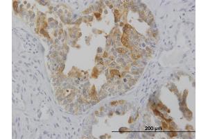Immunoperoxidase of monoclonal antibody to LMTK2 on formalin-fixed paraffin-embedded human ovarian cancer. (LMTK2 antibody  (AA 1181-1280))