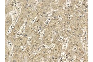 SLC47A2 Mouse Monoclonal Antibody at 1/100 staining human liver cancer and adjacent non-tumor tissue by IHC-P.