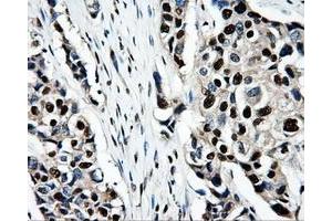 Immunohistochemical staining of paraffin-embedded Adenocarcinoma of ovary tissue using anti-PSMC3mouse monoclonal antibody. (PSMC3 antibody)