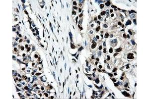 Immunohistochemical staining of paraffin-embedded Adenocarcinoma of ovary tissue using anti-PSMC3mouse monoclonal antibody.