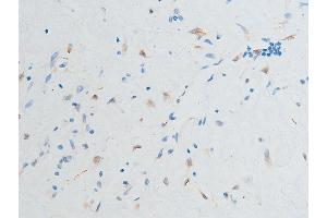 ABIN6267252 at 1/100 staining human glioma tissue sections by IHC-P. (CHEK2 antibody  (pSer516))