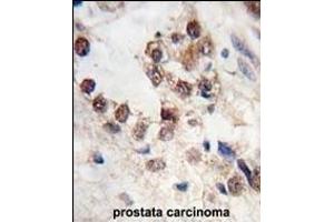 Formalin-fixed and paraffin-embedded human prostata carcinoma tissue reacted with KLF4 antibody (N-term C74) (ABIN389187 and ABIN2839350) , which was peroxidase-conjugated to the secondary antibody, followed by DAB staining. (KLF4 antibody  (AA 69-101))