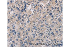 Immunohistochemistry of Human liver cancer using IMPDH1 Polyclonal Antibody at dilution of 1:20 (IMPDH1 antibody)