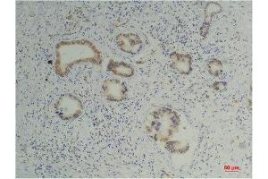 Immunohistochemistry (IHC) analysis of paraffin-embedded Human Pancreatic Carcinoma using Cyclophilin B Mouse Monoclonal Antibody diluted at 1:200. (PPIB antibody)