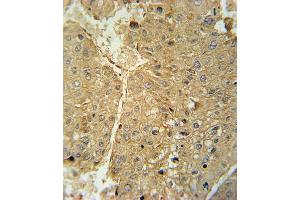 ADH1C Antibody (Center) (ABIN651725 and ABIN2840376) immunohistochemistry analysis in formalin fixed and paraffin embedded human hepatocarcinoma followed by peroxidase conjugation of the secondary antibody and DAB staining. (ADH1C antibody  (AA 231-260))