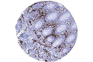 Intense CD56 immunostaining of nerve fibres in the appendix mucosa