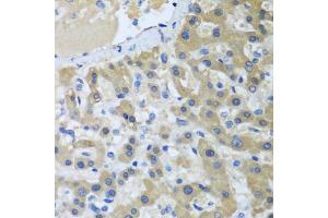 Immunohistochemistry of paraffin-embedded human liver cancer using XPC antibody. (XPC antibody)