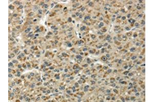 The image on the left is immunohistochemistry of paraffin-embedded Human liver cancer tissue using ABIN7128060(UBL4B Antibody) at dilution 1/25, on the right is treated with fusion protein. (UBL4B antibody)