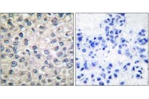 Immunohistochemistry analysis of paraffin-embedded human breast carcinoma tissue, using Catenin-alpha1 Antibody. (CTNNA1 antibody  (AA 857-906))