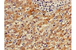 Immunohistochemistry of paraffin-embedded human liver cancer using ABIN7153223 at dilution of 1:100 (FUOM antibody  (AA 1-134))