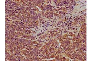 IHC image of ABIN7158034 diluted at 1:200 and staining in paraffin-embedded human lung cancer performed on a Leica BondTM system. (LARS antibody  (AA 614-892))