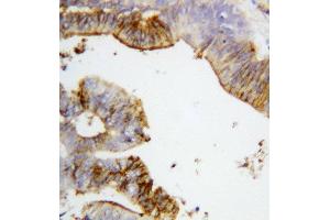 Anti-Annexin A2 antibody, IHC(P) IHC(P): Human Intestinal Cancer Tissue (Annexin A2 antibody  (Middle Region))