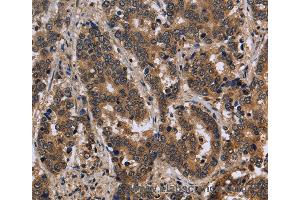 Immunohistochemistry of Human liver cancer using FMR1 Polyclonal Antibody at dilution of 1:30 (FMR1 antibody)
