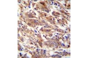 Immunohistochemistry analysis in formalin fixed and paraffin embedded human breast carcinoma reacted with FBXW12 Antibody (C-term) followed by peroxidase conjugation of the secondary antibody and DAB staining. (FBXW12 antibody  (C-Term))