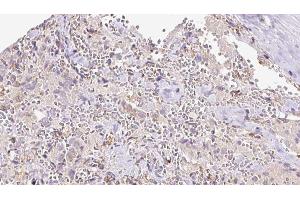 ABIN6273308 at 1/100 staining Human thyroid cancer tissue by IHC-P. (REEP6 antibody  (C-Term))