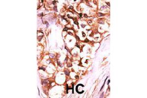Formalin-fixed and paraffin-embedded human hepatocellular carcinoma tissue reacted with DUSP8 polyclonal antibody  , which was peroxidase-conjugated to the secondary antibody, followed by AEC staining. (DUSP8 antibody  (C-Term))