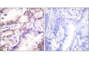 Immunohistochemistry analysis of paraffin-embedded human lung carcinoma tissue, using CTIP (Ab-327) Antibody. (Retinoblastoma Binding Protein 8 antibody  (AA 293-342))