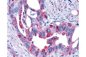 Anti-FZD4 / Frizzled 4 antibody IHC of human Pancreas, Carcinoma. (FZD4 antibody  (N-Term))