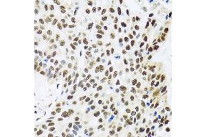Immunohistochemistry of paraffin-embedded human lung cancer using FUBP1 antibody (ABIN5973257) at dilution of 1/100 (40x lens).