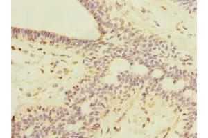 Immunohistochemistry of paraffin-embedded human breast cancer using ABIN7168420 at dilution of 1:100 (ROPN1L antibody  (AA 1-230))