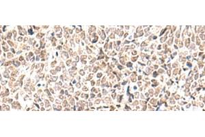 Immunohistochemistry of paraffin-embedded Human lung cancer tissue using EWSR1 Polyclonal Antibody at dilution of 1:70(x200) (EWSR1 antibody)