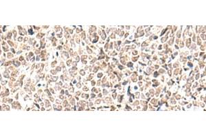 Immunohistochemistry of paraffin-embedded Human lung cancer tissue using EWSR1 Polyclonal Antibody at dilution of 1:70(x200) (EWSR1 antibody)