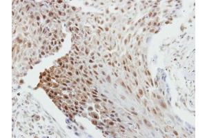 IHC-P Image Immunohistochemical analysis of paraffin-embedded human breast cancer, using Bcl-2, antibody at 1:250 dilution. (Bcl-2 antibody  (N-Term))