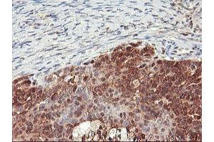 Immunohistochemical staining of paraffin-embedded Adenocarcinoma of Human ovary tissue using anti-NLN mouse monoclonal antibody.