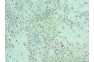 Immunohistochemistry of paraffin-embedded human breast cancer using ABIN7143956 at dilution of 1:100 (ALS2 antibody  (AA 1-280))