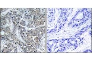 Immunohistochemistry analysis of paraffin-embedded human breast carcinoma tissue, using Stathmin 1 (Ab-15) Antibody. (Stathmin 1 antibody  (AA 5-54))